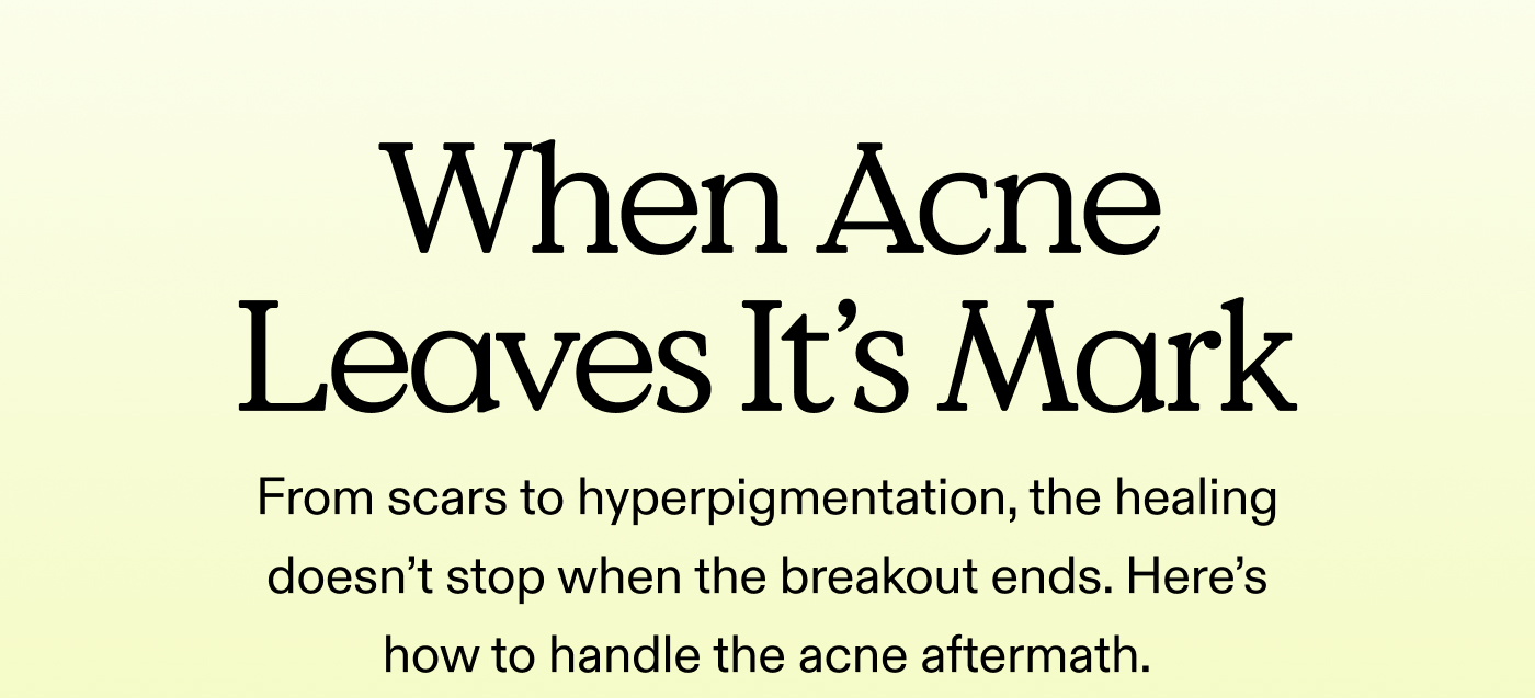 When Acne Leaves Its Mark From scars to hyperpigmentation, the healing doesn’t stop when the breakout ends. Here’s how to handle the acne aftermath.