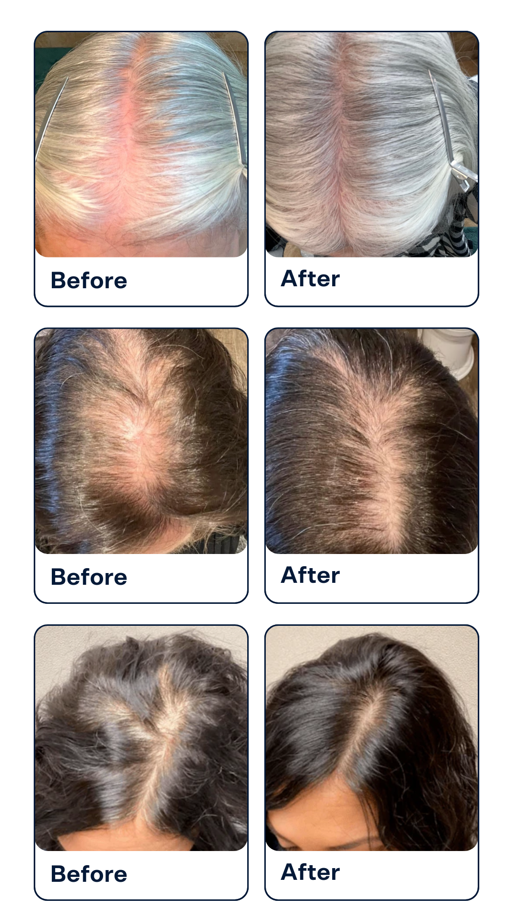 Adegen for Women Hair Loss