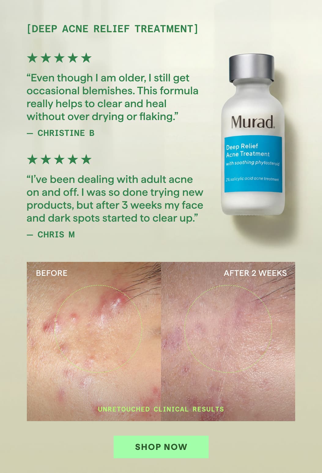 Deep Relief Acne Treatment Shop Now