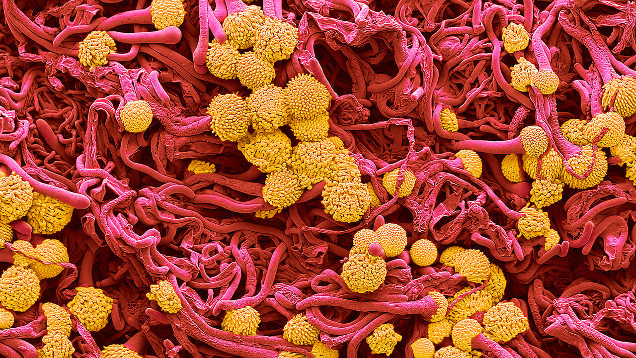 Drug resistant aspergillus. 