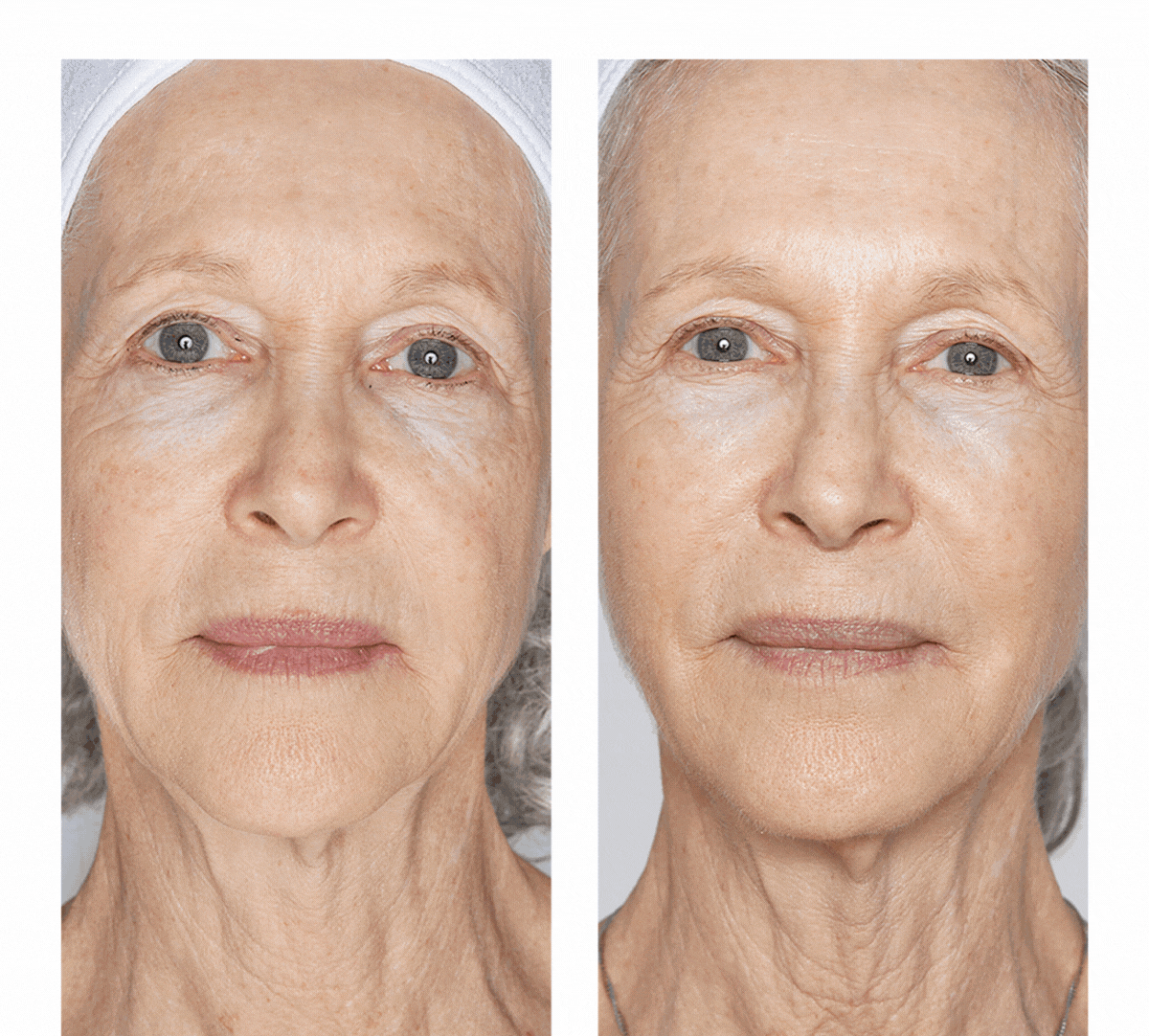 Customer Before & After Results Using Cell Forté Serum or Cell Forté Serum & Eye Crème