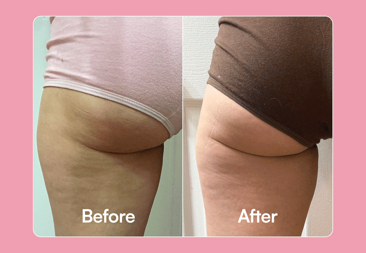 Before - After