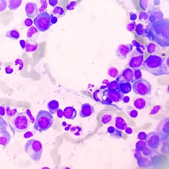 A microscopic view of a slide showing multiple myeloma cells