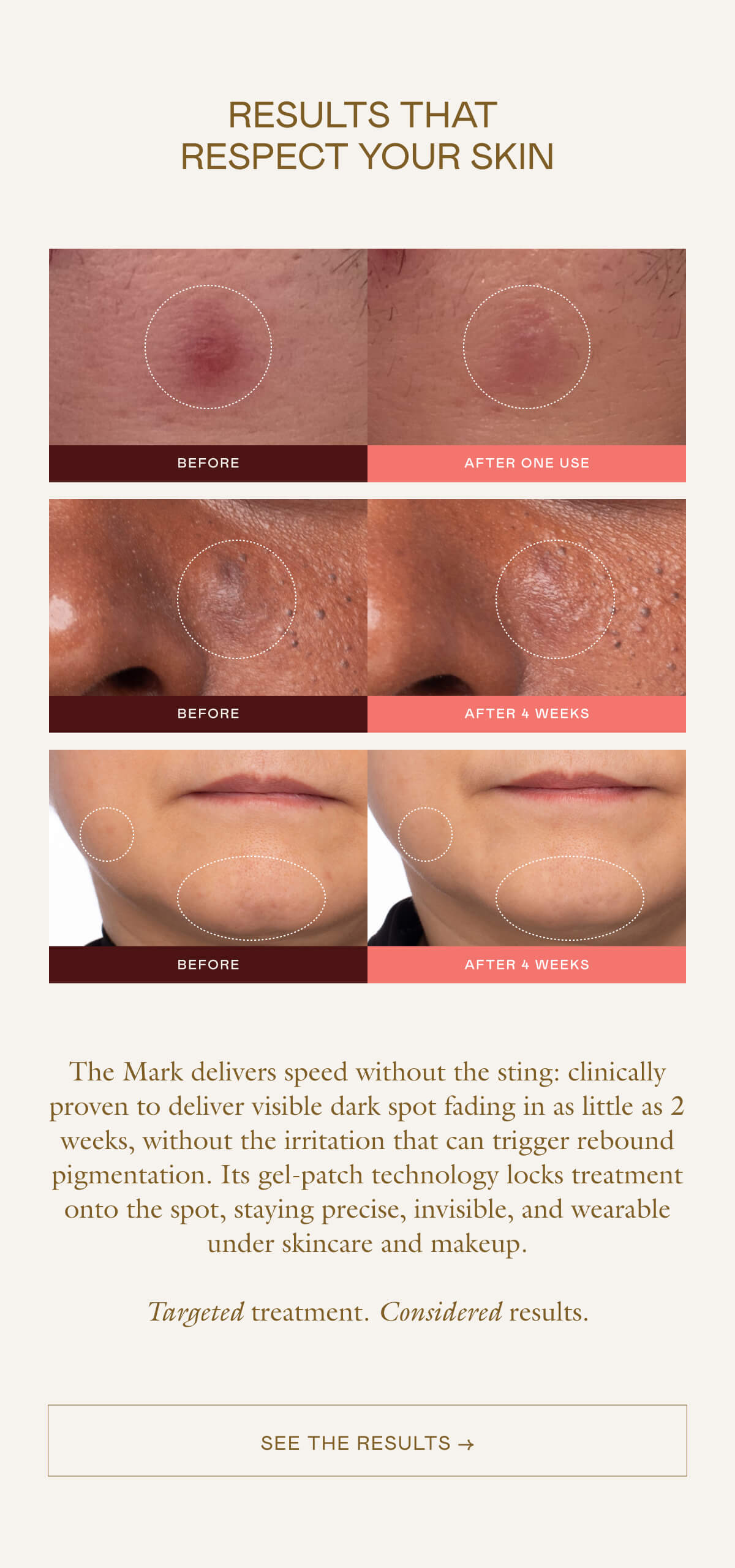The Mark delivers speed without the sting: clinically proven to deliver visible dark spot fading in as little as 2 weeks, without the irritation that can trigger rebound pigmentation. Its gel-patch technology locks treatment onto the spot, staying precise, invisible, and wearable under skincare and makeup.  Targeted treatment. Considered results.