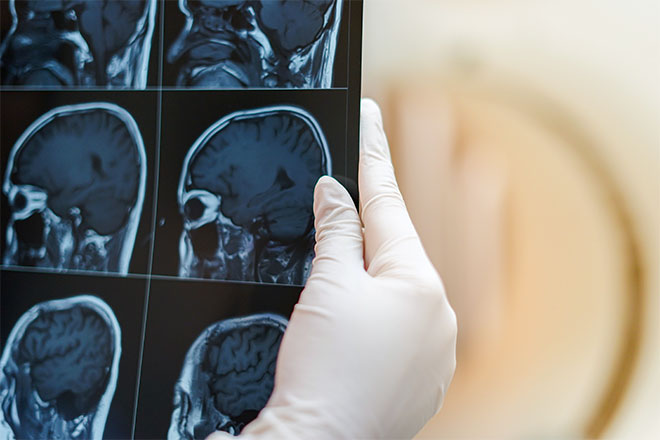 A gloved hand holding scans of the brain.
