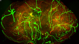 Illustration of cells in melanoma