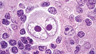 Lymphoma