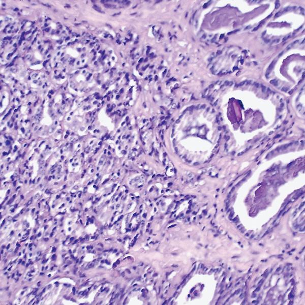 A section of a prostate gland containing numerous cancer cells