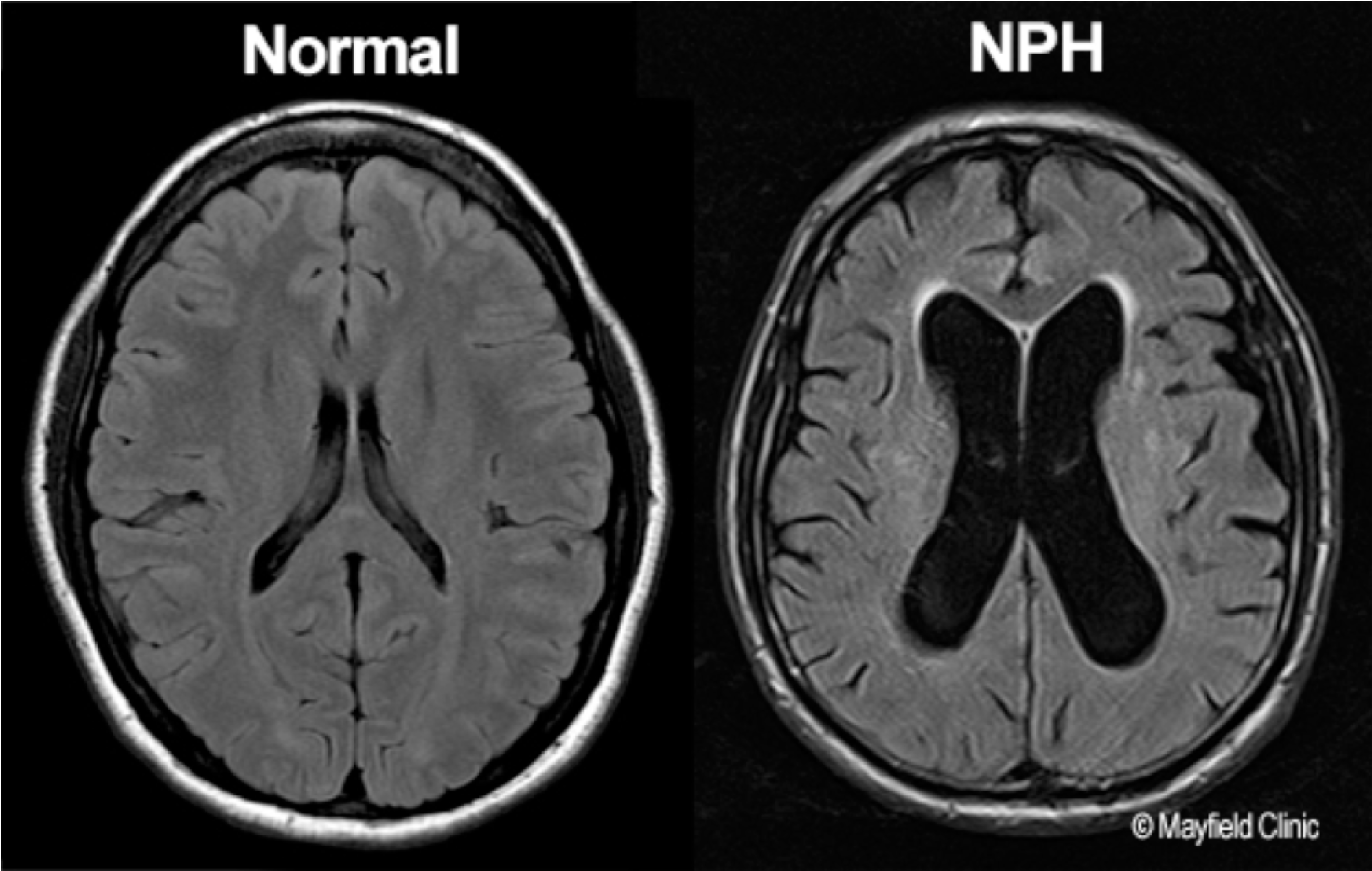 A brain with normal pressure hydrocephalus
