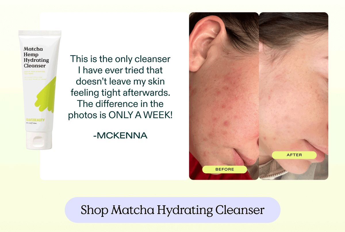 "This is the only cleanser I have ever tried that doesn't leave my skin feeling tight afterwards. The difference in the photos is ONLY A WEEK!" - McKenna. Shop Matcha Hydrating Cleanser