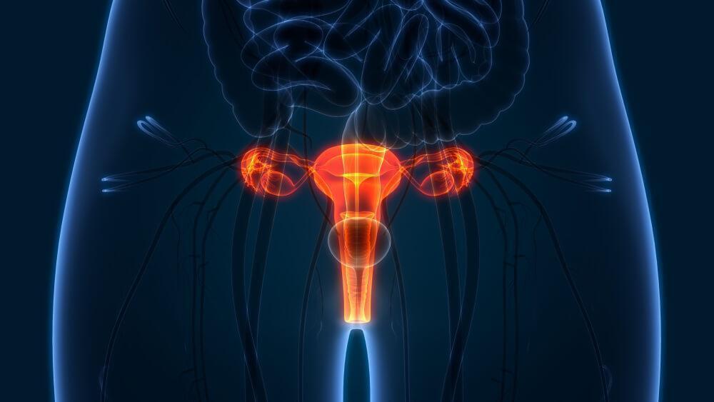 Ovarian Cancer
