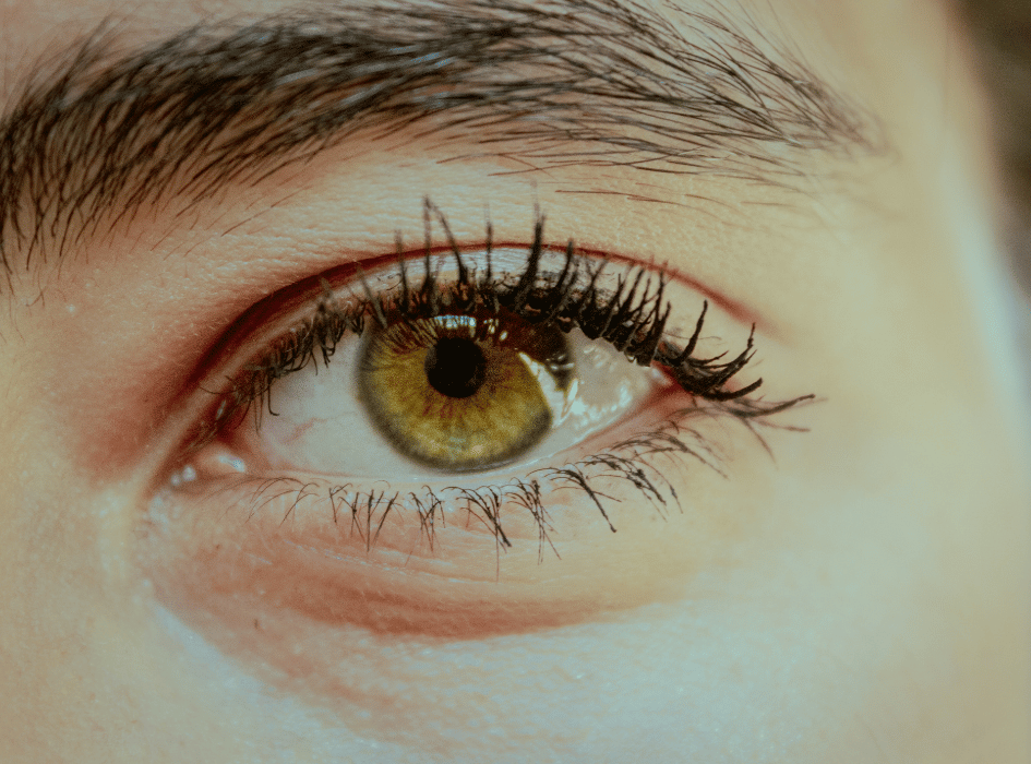 Close up of Woman with puffy Eye Bags