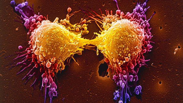 SEM of two prostate cancer cells in the final stage of cell division (cytokinesis)