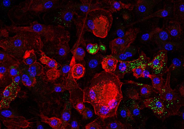 Microscopy image showing senescent macrophages in red and cholesterol-laden lipid droplets in green