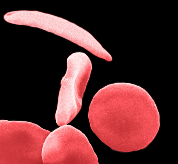 Healthy red blood cells surround a rigid, sickle-shaped cell in this scanning electron micrograph.