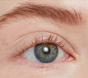 Woman with short, sparse lashes