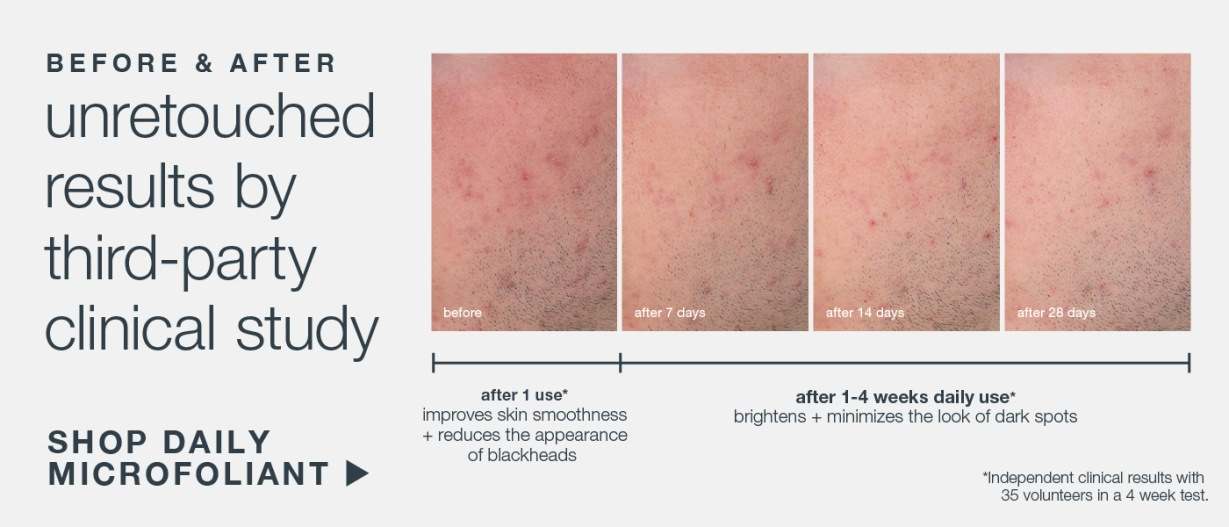 before & after | unretouched results by third party clinical study | SHOP DAILY MICROFOLIANT | after 1 use* improves skin smoothness + reduces the appearance of blackheads| after 1-4 weeks daily use* brightens + minimized the looks of dark spots | *independent clinical results with 3 bolunteers in a 4 week test 