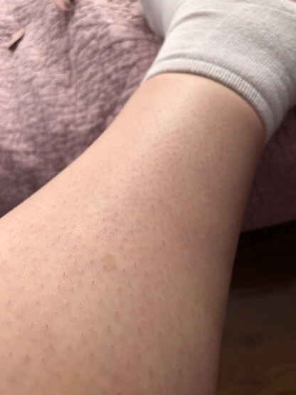 Lower Leg
