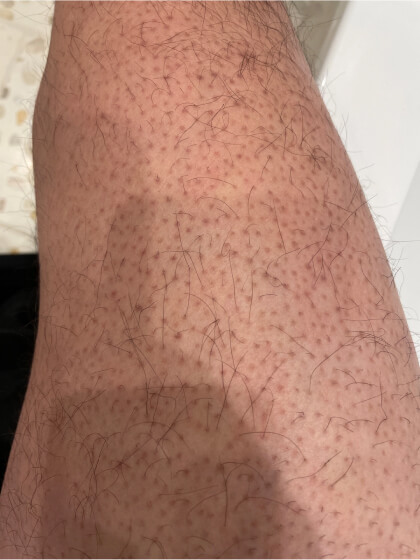 Upper Leg