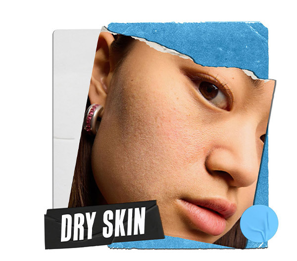 Dry Skin