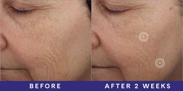 Before, visible lines and texture around corners of mouth. After 2 weeks, smoother skin around corners of mouth.