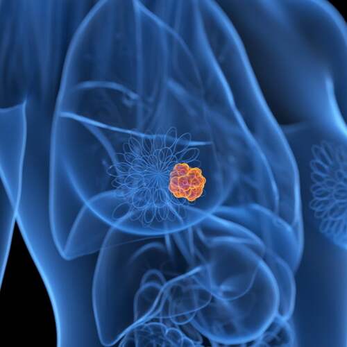 Is AI Good at Detecting Breast Cancer? First Major Study Aims to Find Out