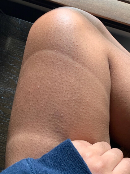 Upper Leg