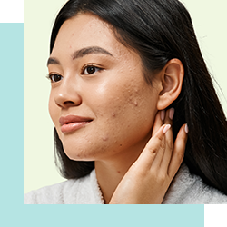 Woman with minor acne smiling