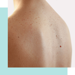 Woman's back with red freckles