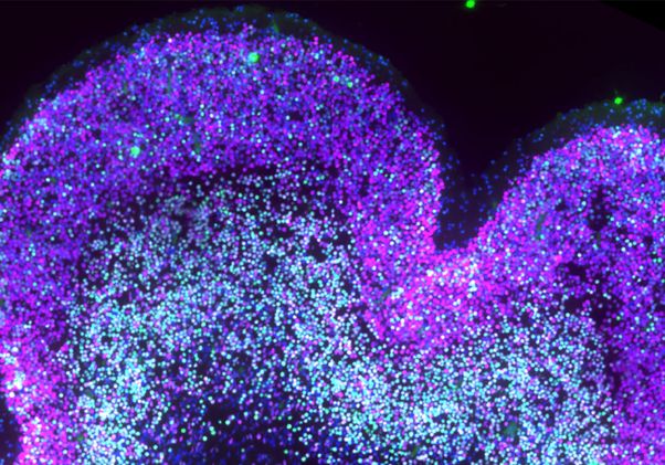 Developing Down syndrome neocortex intratelencephalic neurons in magenta and deep-layer neurons in green